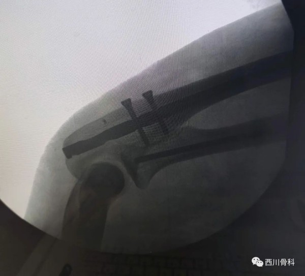 复杂问题简单化，能微创不切开